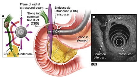 gall bladder ultrasound prep instructions